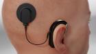 Cochlear Hearing Implants