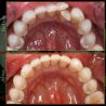 Dental Implants Columbus in Ohio -  Dublin Metro Dental