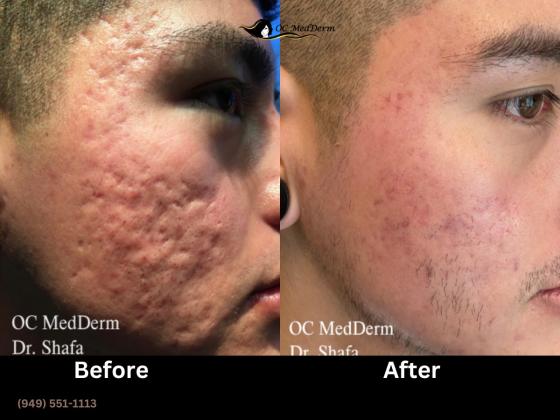 Acne scar treatment Irvine Irvine, California | OC MedDerm | Irvine skin
