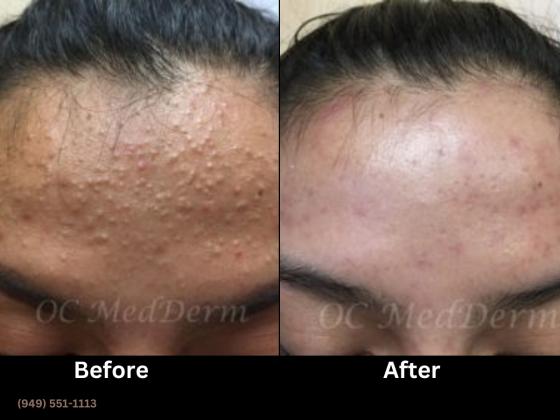 Best acne treatment by Dr. Parvin Shafa in Irvine, CA | OC MedDerm | Orange County