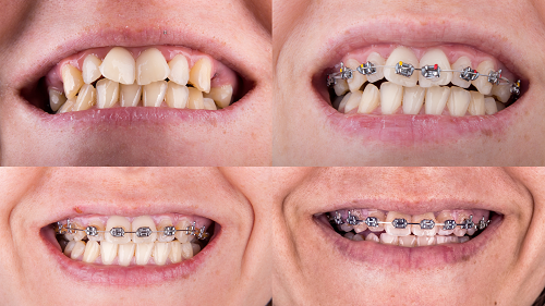 Dental Bonding Before and after