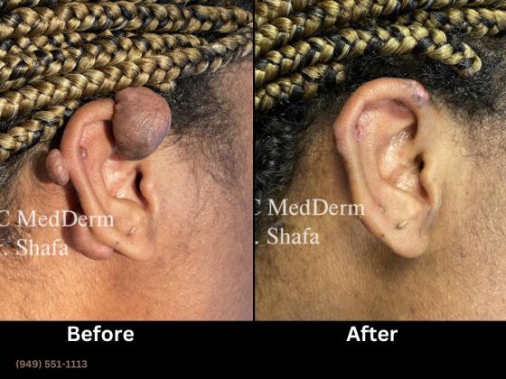Keloid Treatment in Irvine and Orange County, CA - OC MedDerm | Irvine Skin