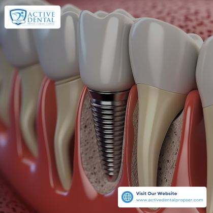 Transform Your Smile with Dental Implants Prosper
