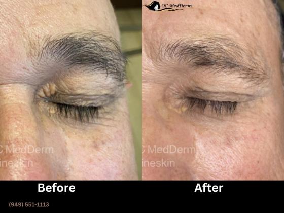 Xanthelasma Removal in Irvine, California | OC MedDerm | Irvineskin