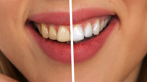 Zoom Teeth Whitening