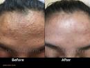 Best acne treatment by Dr. Parvin Shafa in Irvine, CA | OC MedDerm | Orange County