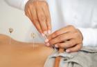 Best Fertility Acupuncture NYC