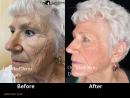 Co2 laser treatment Irvine, California | OC MedDerm | Irvine skin