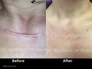 Keloid Removal treatment Irvine, California | OC MedDerm | Irvineskin