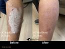 Psoriasis Treatment Specialist in Irvine, California | OC MedDerm | Irvine skin