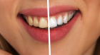 Zoom Teeth Whitening