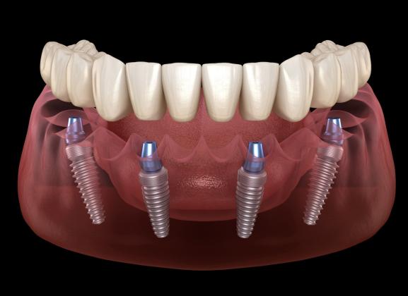 All-on-4 Dental Implants in Tijuana, Mexico – Affordable, Life-Changing Results!