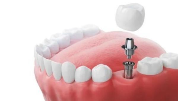 Best Dental Implant in Jadavpur