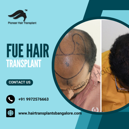Best FUE Hair Transplant in Bangalore | FUE Hair Transplant Cost