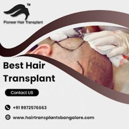 Best Hair Transplant in Bangalore | Hair Transplant Clinic