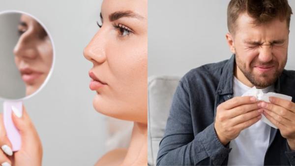 Rhinoplasty Cosmetic Surgery