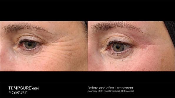 Wrinkle and Cellulite Reduction Treatment by Chiropractor