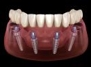 All-on-4 Dental Implants in Tijuana, Mexico – Affordable, Life-Changing Results!