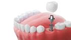 Best Dental Implant in Jadavpur