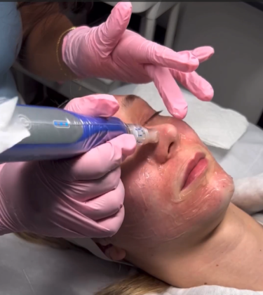 Best Botox Treatment in Colorado Springs: Say Goodbye to Wrinkles!