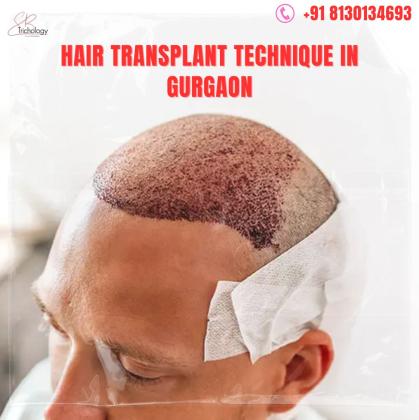 Hair Transplant Technique In Gurgaon | Book Your Appointment Now