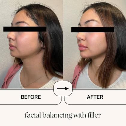 Laser Facial Near me