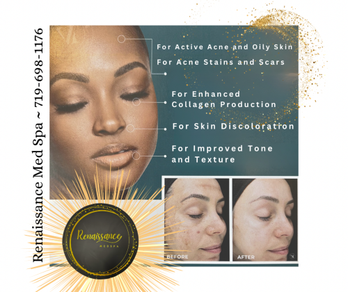 Revitalize Your Skin with Vi Peel Treatment in Colorado Springs