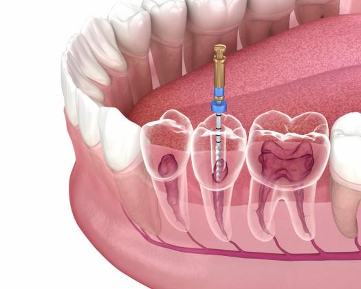 Root Canal Treatment Cost: Factors, Prices & What to Expect