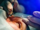 Best Ophthalmologist In San Antonio Tx