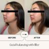 Laser Facial Near me