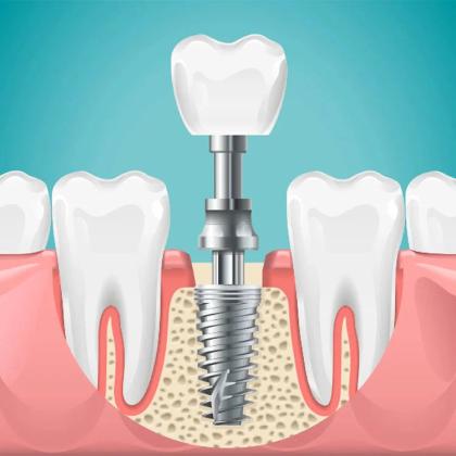 Cost of One Dental Implant in India: Pricing & Details