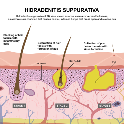 Hidradenitis Suppurativa