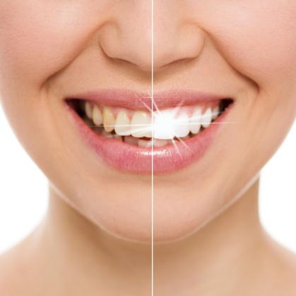 Professional Results with At-Home Teeth Whitening