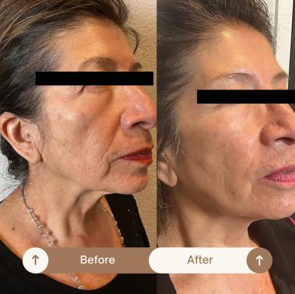 Revitalize Your Skin with Intense Pulsed Light (IPL) Face Treatment in Colorado Springs