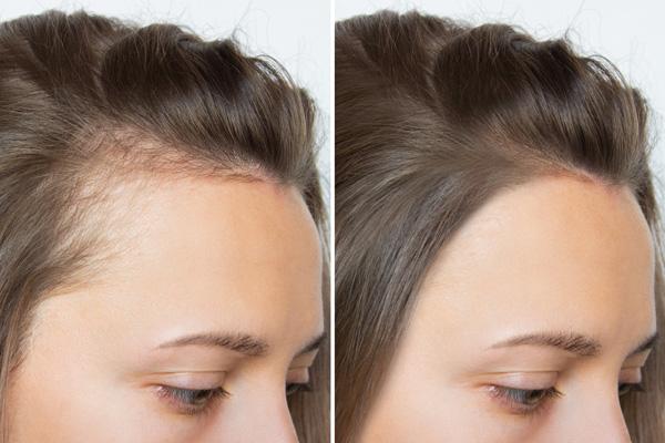 Scalp micropigmentation Vancouver – A Hairline Makeover Without the Commitment of Hair