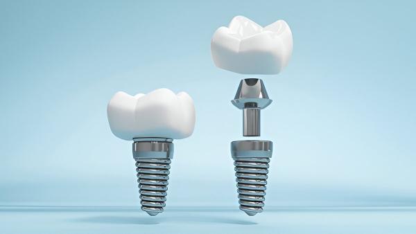 Siiodent Implants: Leading Dental Implant USA Manufacturer