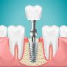 Cost of One Dental Implant in India: Pricing & Details