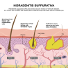 Hidradenitis Suppurativa