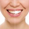 Professional Results with At-Home Teeth Whitening