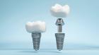 Siiodent Implants: Leading Dental Implant USA Manufacturer