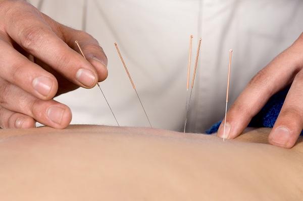 Acupuncture NYC