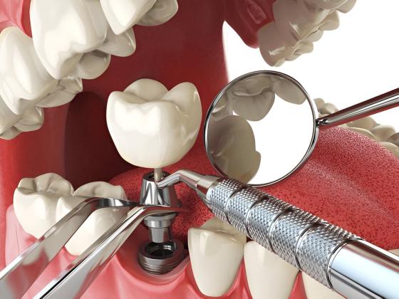 Advanced Healing Abutments for Hex Implant – Siiodent Implants Innovation