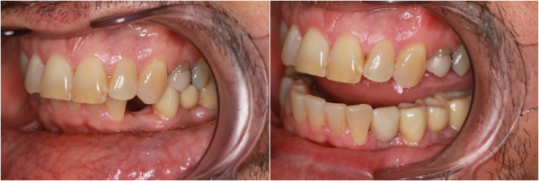 Affordable Dental Implants in Columbus | Dublin Metro Dental