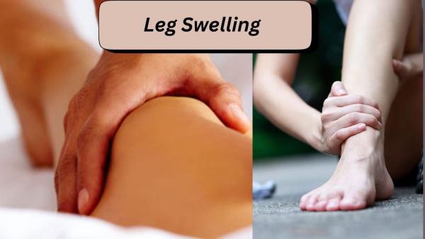 Does leg swelling affect circulation?