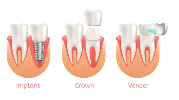 Get a Perfect Smile with Same-Day Crowns in Las Vegas!