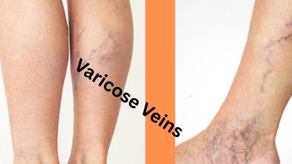 How to Determine If Your Varicose Veins Are Genetic?