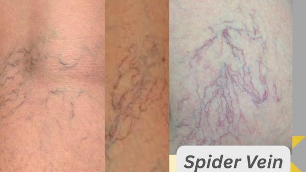 Transform Your Skin: Benefits of Laser Spider Vein Removal