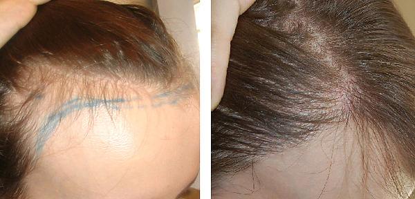 Scalp Tattoo Near Me: Conceal Your Hair Loss