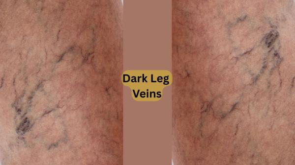 Why are my veins so dark all of a sudden?