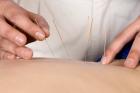 Acupuncture NYC